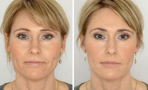 Photos before and after using the cream, experience of use Coralift Valerie de Paris