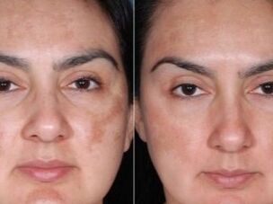 Before and after the rejuvenation procedure