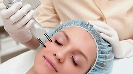 Face laser rejuvenation